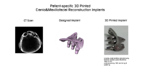 KUZMA Industrial 3D printed Maxillofacial Implant